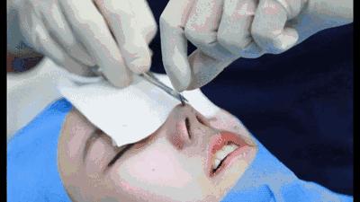 线雕鼻做了好看吗,鼻子短做线雕隆鼻好看吗