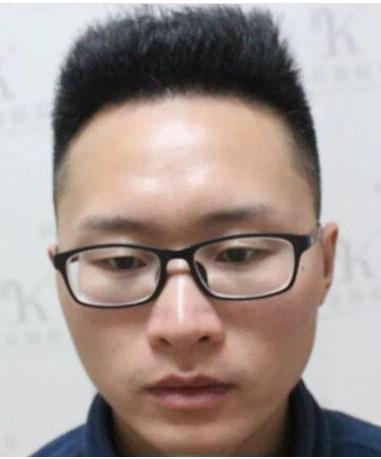 男性m型脱发是脂溢性脱发吗,m型脱发还在继续脱发怎么办