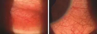 干眼症为什么要查过敏原,怎么判断是过敏还是干眼