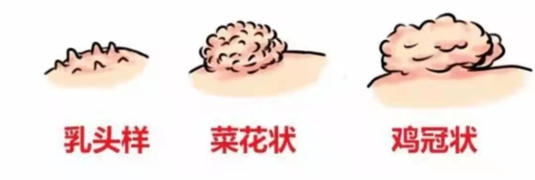 尖锐性湿疣反复发作怎样治疗,尖锐性湿疣怎么不容易复发