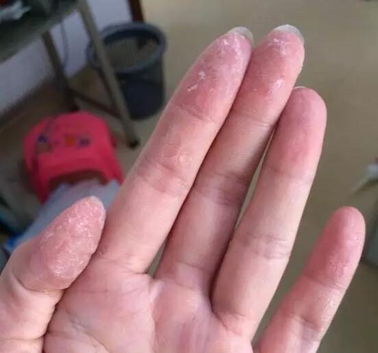 502胶水把手粘起来了怎么办,如果手被502胶水粘住了怎么办