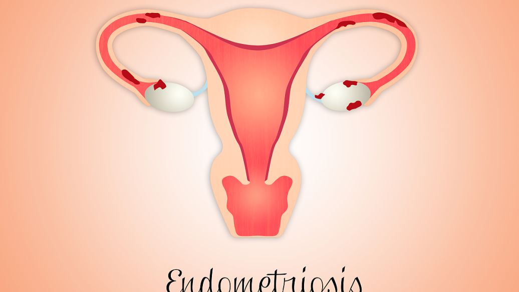 中医治疗多囊卵巢综合症需要多久,多囊卵巢综合征闭经2年了