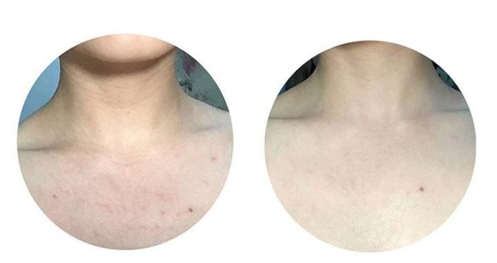 护理鸡皮肤的正确方法,身上的鸡皮肤怎样才能彻底消除