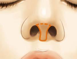 鼻小柱缺陷怎么治,鼻小柱和鼻翼不在一条水平线