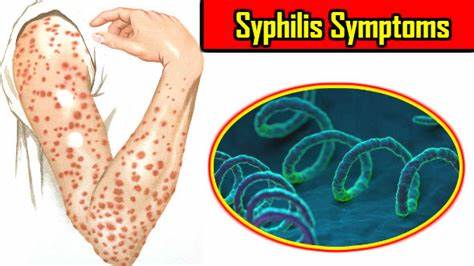 辟谣！梅毒阳性者，能通过生活接触传染他人？和感染科医生聊一聊