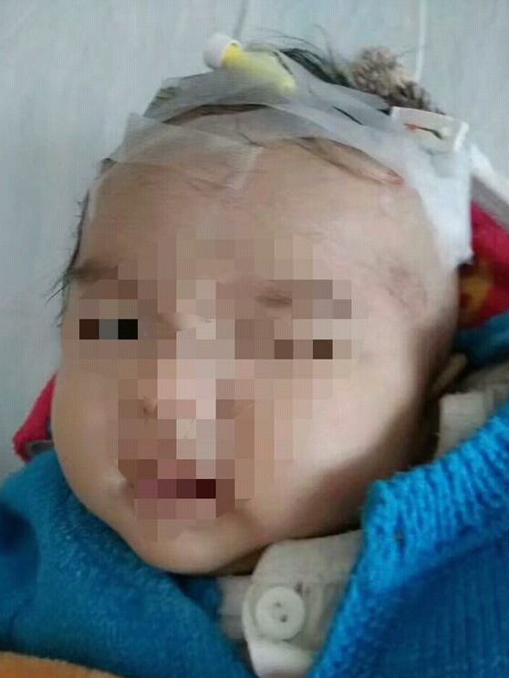 我生了水囊瘤的宝宝,得了淋巴管瘤能生孩子吗