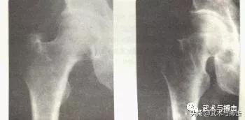 胯松了是什么原因,胯松开是什么感觉