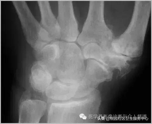 软组织钙化是不是骨化性肌炎,软组织钙化或骨化