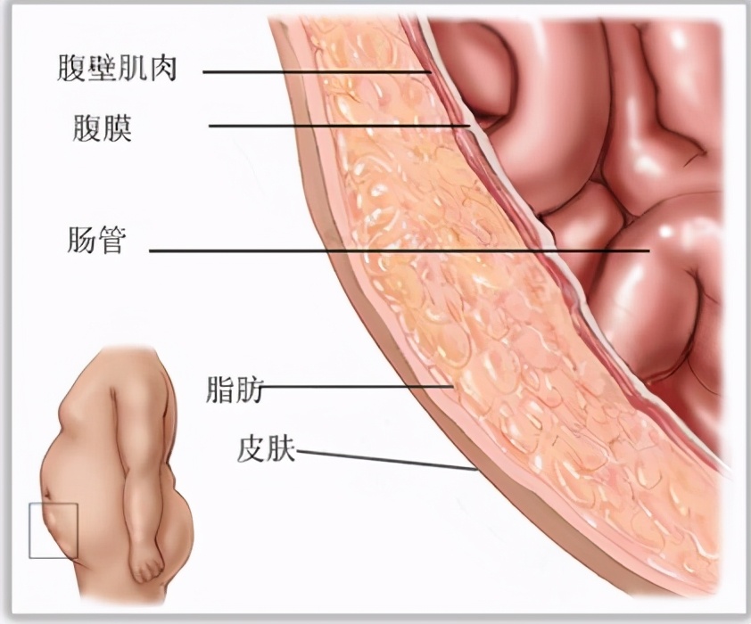 腹部手术后如何预防切口疝,腹部疝气手术并发症