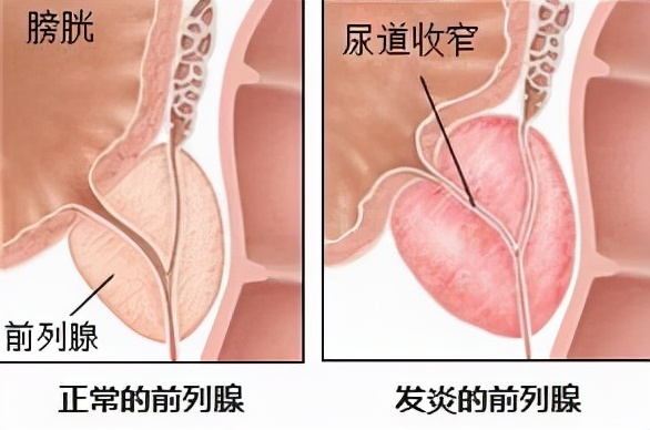 男性小腹三角区痛小便困难,男子排尿不顺