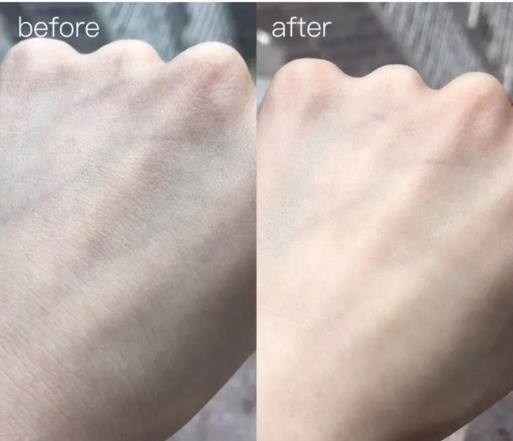 脸上长痘痘的原因和注意事项,脸上长痘痘到底应该怎么解决