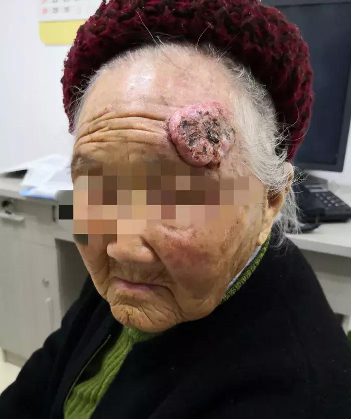 百岁老人头上长出犄角是皮肤癌吗,百岁老人头上长疙瘩