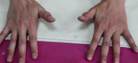 手指疲劳腱鞘炎,拇指腱鞘炎锻炼方法