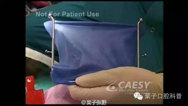 上牙龈上火突出一个鼓包,牙龈肿胀鼓包上火了吗