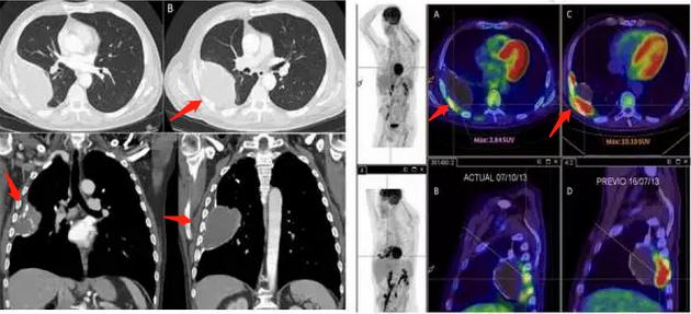 脓胸手术后完全恢复,脓胸患者出院以后抗感染治疗多久