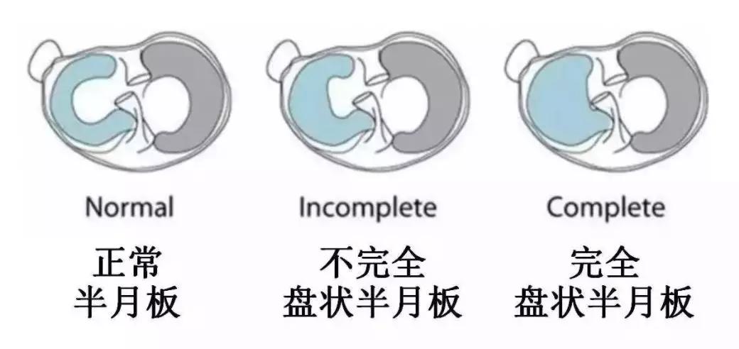 每个人的半月板都一样的吗,你见过长得跟你一模一样的人吗