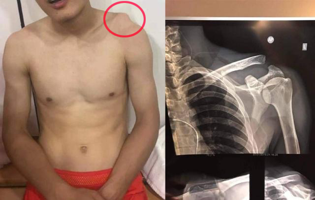 什么是封闭疗法,运动员打封闭针对身体的危害