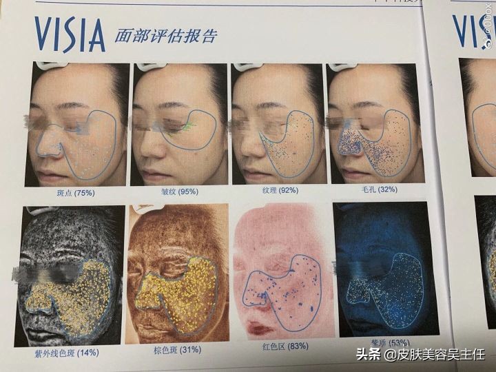 visia皮肤检测分高低吗,visia皮肤检测值多少是正常的