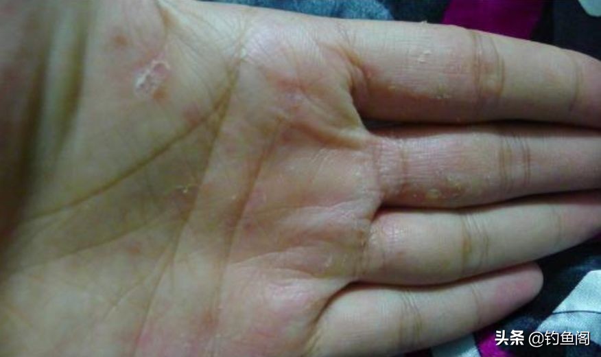 钓鱼香虎手能彻底根除吗,香虎手治好后还能钓鱼吗