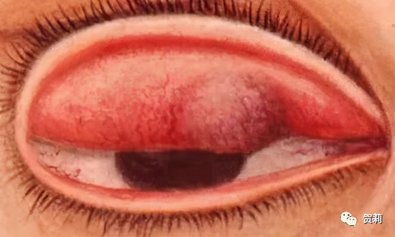 睑板腺囊肿眼皮图片,睑板腺囊肿眼皮肿怎么办