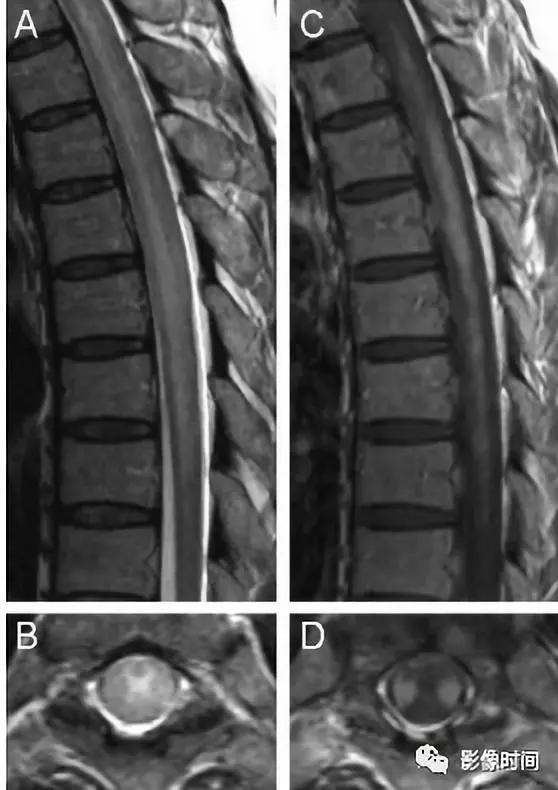 脊髓病变案例图文问诊,脊髓病变视频