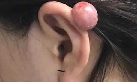 打耳洞打出个肉疙瘩,打耳洞长出肉疙瘩的概率多大