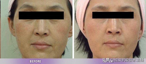 面部拉皮除皱整形多少钱一次,面部除皱拉皮手术价格是多少