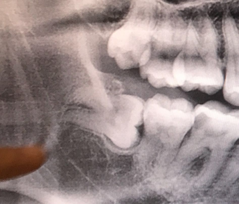 拔智齿痛苦的真实经历,拔智齿去了3次花了近1千