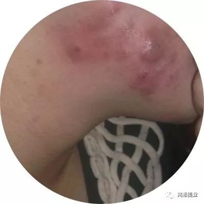 如何分辨痘痘的类型和长痘的原因,如何判断自己长的痘痘是哪种痘痘