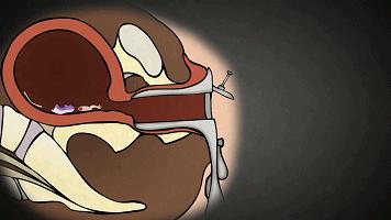 疤痕妊娠流产最好方法,各种流产方式总结