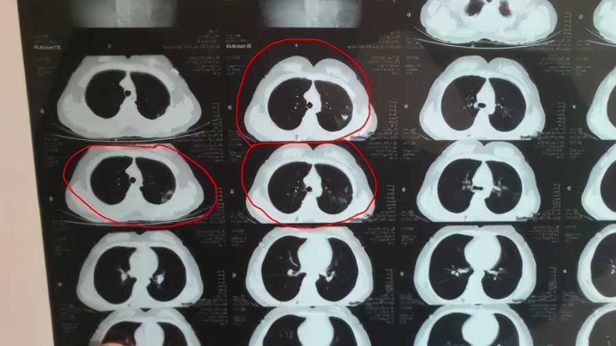 怀孕三个月后老公确诊肺结核,怀孕3个月我老公查出肺结核