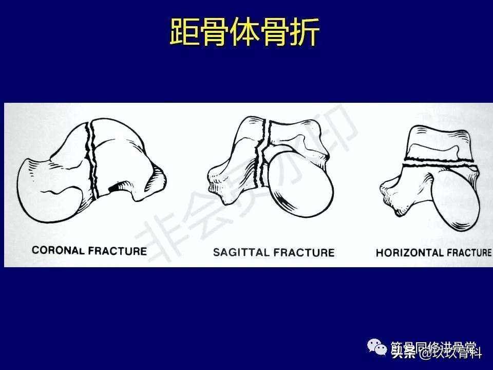 距骨骨折后遗症,距骨骨折怎么办