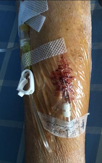 病人拒绝治疗护士怎么办,患者拒绝打留置针可以吗