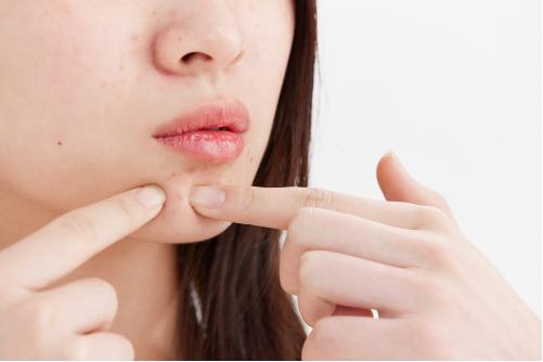 痘痘闭口怎么快速消下去,治疗痘痘闭口最好的办法