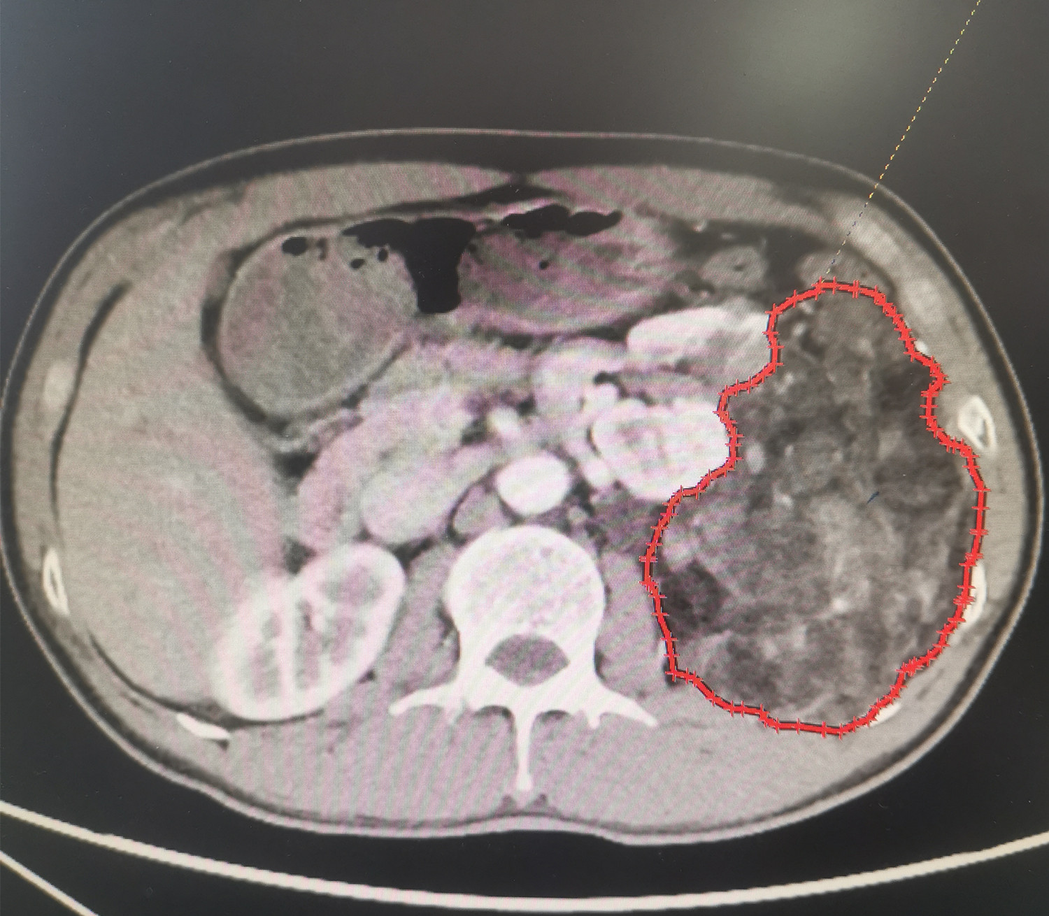 肾脏上多大的肿瘤能转移,肾上长了个瘤子而且影响排尿