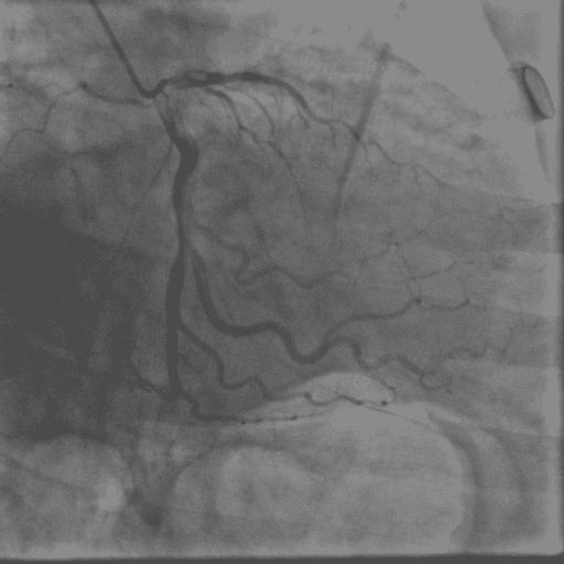 心电图上t波改变啥意思,心电图上t波改变