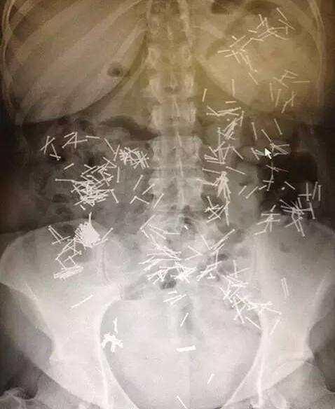 不作死就不会死，看看这些被人类搞进身体里的异物