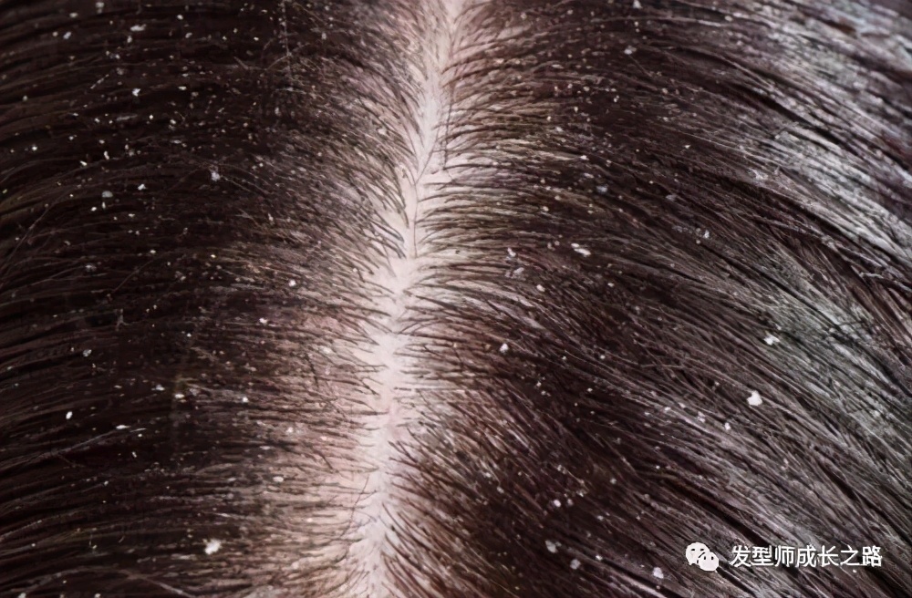 你真正了解ros吗,怎么真正治疗头皮屑
