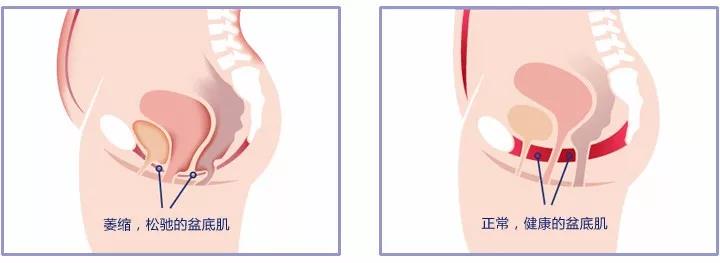 盆底肌电评估及生物反馈报告,生物刺激反馈治疗盆底肌修复