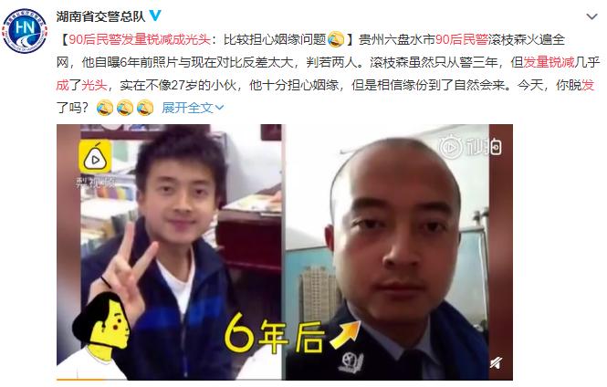 脱发和头发长有关系,脱发导致发际线一直往后拖