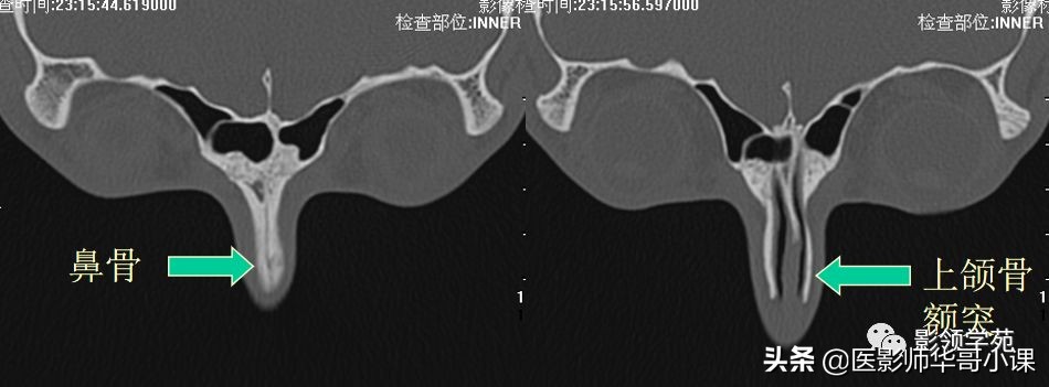 「鼻骨彩图」鼻骨CT解剖及骨折影像学诊断