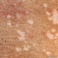 皮肤干燥脱皮10分钟清晨急救法,皮肤干燥尤其是秋冬会全身脱皮