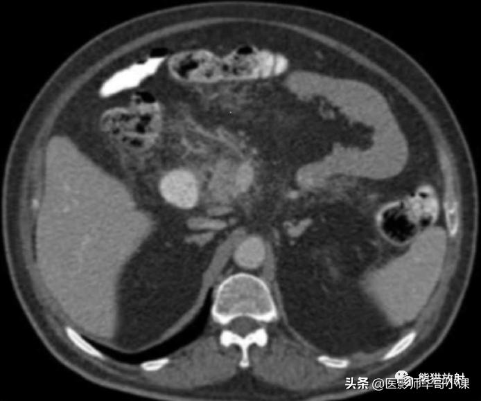 「精品课件」11种腹膜感染/炎症性病变的影像学表现