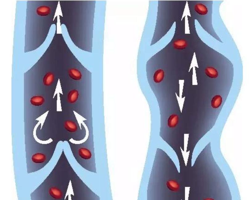 腿上长蚯蚓有哪些东西要戒掉,腿上有小蚯蚓怎么办