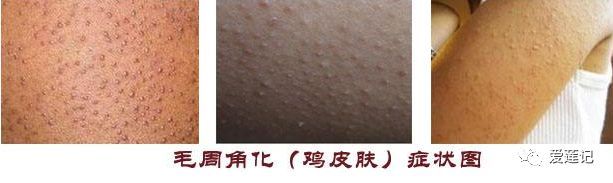 去除手上鸡皮,去除手臂上的鸡皮肤