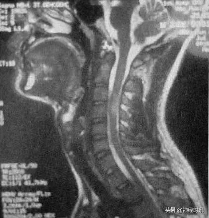 中医治疗多发性硬化的成功病例,今日病例