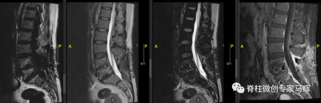 腰椎脓肿会发烧吗,腰间盘突出引起下肢疼痛发烧