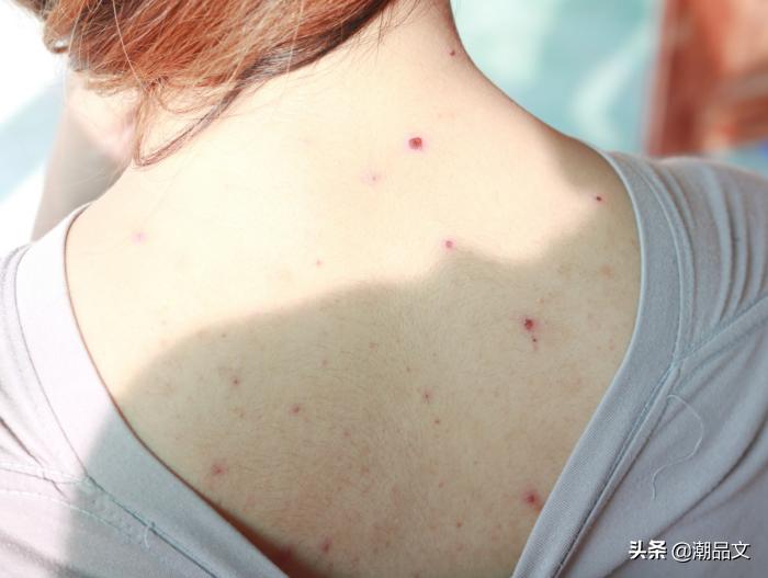 大红痘痘怎么快速消除后背,热天后背长痘痘的原因和解决方法