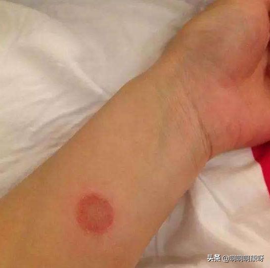 如何判断自己得了猫癣,如何判断猫得了猫癣