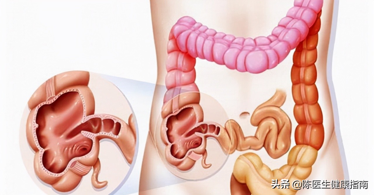 肠内有息肉都会出现哪些症状,肠内有息肉会有何症状